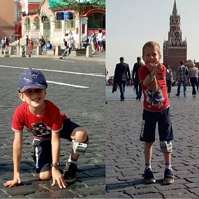 Система функциональной электростимуляции (нейро-ортез) WalkAide I для педиатрического пациента